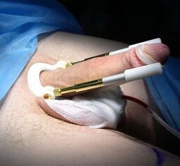 As an operation to increase the penis is performed