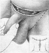 Surgical lengthening of the penis, removing its hidden part